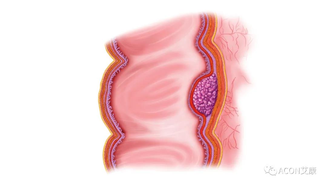 因為忽視身體出現(xiàn)的這些變化，他們最后被確診結(jié)腸癌