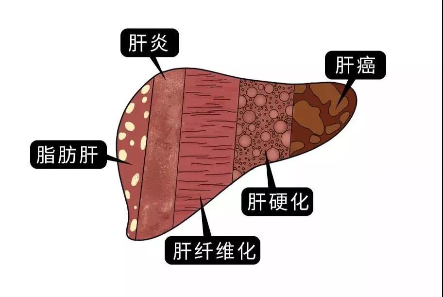 脂肪肝的最大敵人不是肥胖，答案竟是這樣！