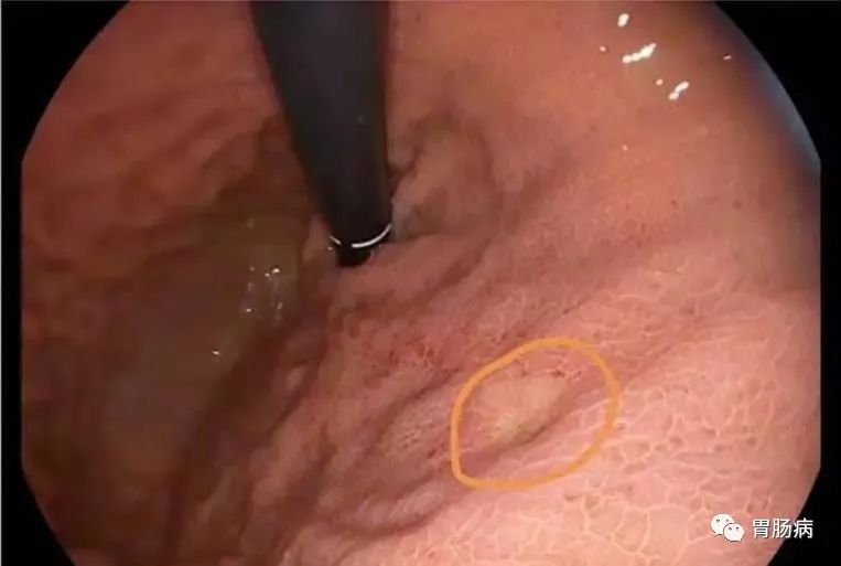 醫(yī)生總結(jié)了3位年輕胃癌患者的病例：30歲不到的他們到底干啥了？