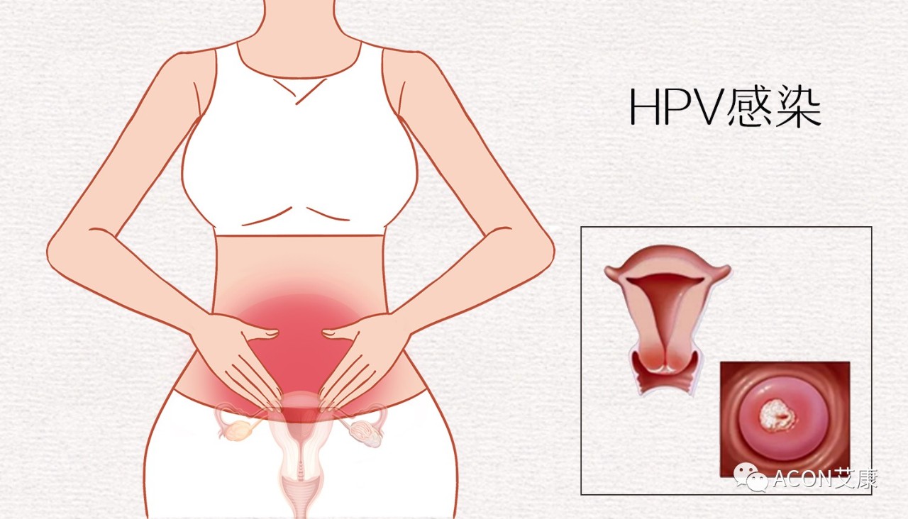 HPV轉(zhuǎn)陰其實(shí)很簡(jiǎn)單， 女性必知的宮頸癌真相