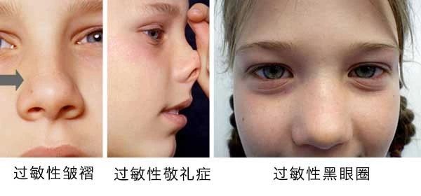 過敏性鼻炎會讓孩子變傻？！家長該如何應(yīng)對